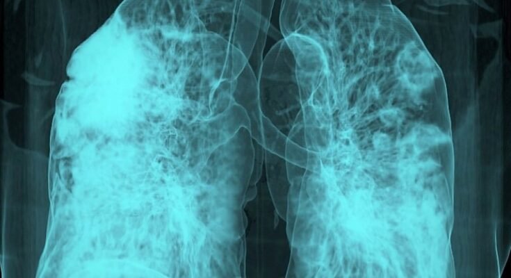 CT 3D CT du sein d'un patient atteint de Covid-19 montrant des verreries moulues multifocales dans les deux poumons.