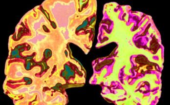 Tranches Les sections de deux cerveaux - à gauche est un cerveau normal coloré dans la pêche et l'orange, et à droite, un cerveau avec la maladie d'Alzheimer est coloré en rose et en vert et est beaucoup plus petit