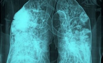 CT 3D CT du sein d'un patient atteint de Covid-19 montrant des verreries moulues multifocales dans les deux poumons.